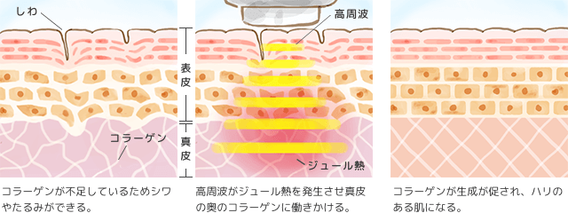 RF(高周波)機能の説明